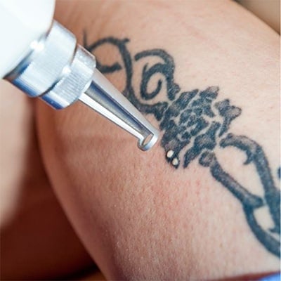 laser tattoo removal treatment