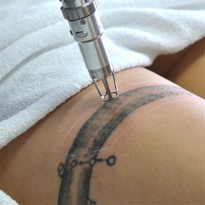 laser tattoo removal training course