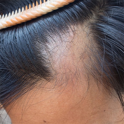 hair loss prp treatment