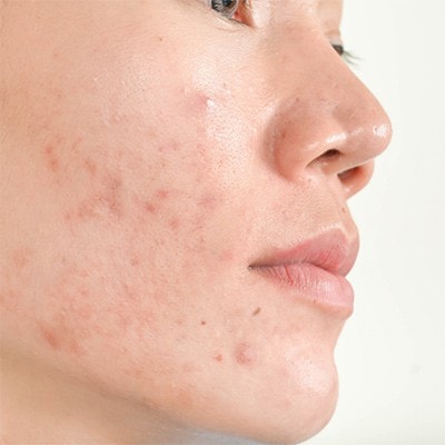 acne - skin conditions