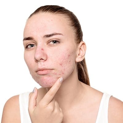 acne skin condition