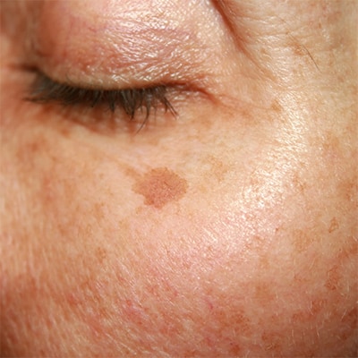 dark spot skin conditions - pigmented stain