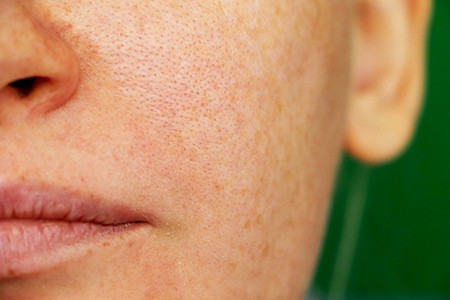 dilated pores skin conditions