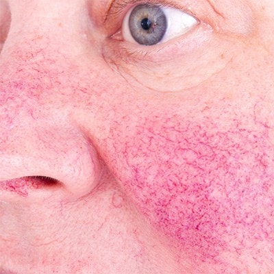 rosacea skin conditions