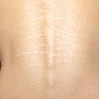 stretch marks skin condition